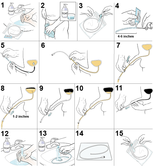 15 steps showing how a male inserts a urinary catheter.