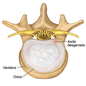 Vista superior de las vértebras lumbares y el disco donde se observa un desgarro en el anillo.